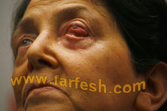 تستعيد بصرها بعد زراعة سن في عينها!!!