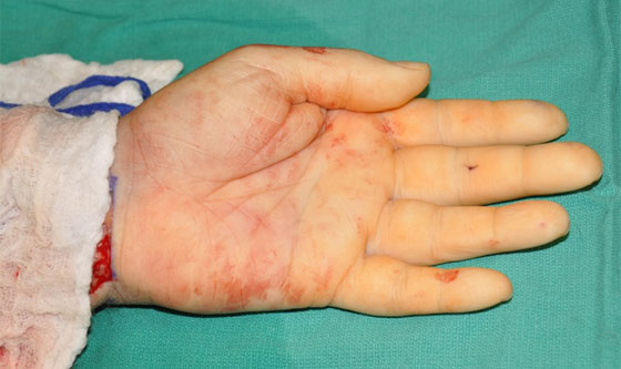 عملية زرع يدين لامريكي بترت راحتيه تتكلل بالنجاح!