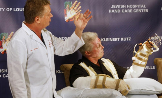 عملية زرع يدين لامريكي بترت راحتيه تتكلل بالنجاح!