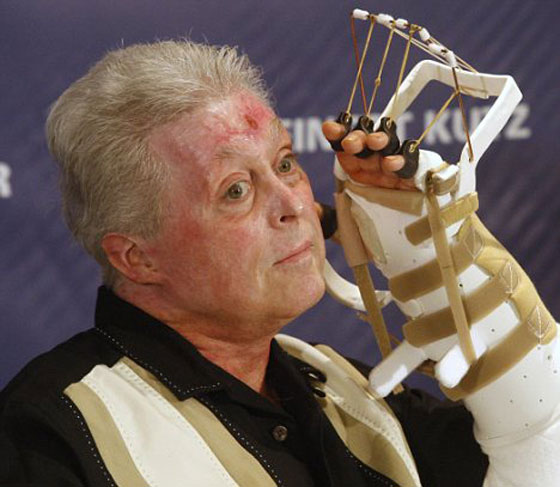 عملية زرع يدين لامريكي بترت راحتيه تتكلل بالنجاح!