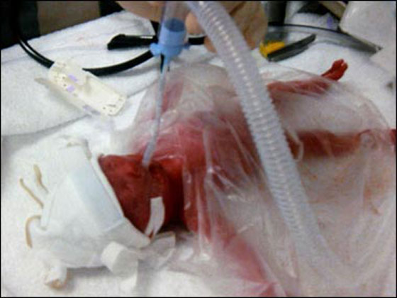 كيس سندويشات في مطبخ المستشفى يبقي المولودة حيّة 