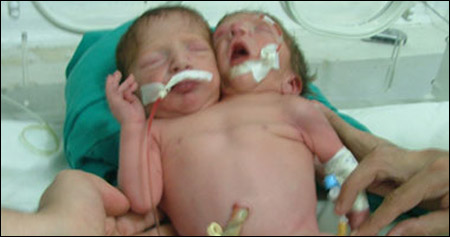 في حالة نادرة.. توأمان ملتصقان بالكامل ما عدا الرأس والعنق!!