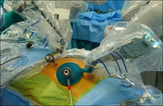 آلة ذاتية الحركة تنجح في اجراء جراحة زراعة بنكرياس!