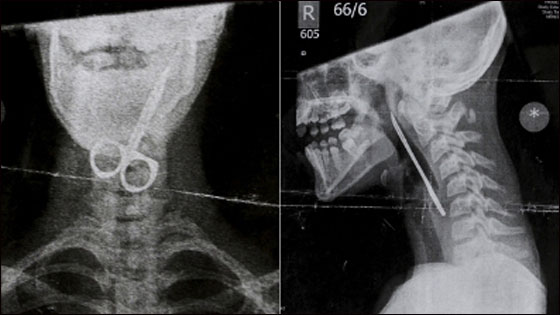 ابتلع مقص أظافر وبدأ يسعل دماً.. لكنه نجا باعجوبة! ابتلع مقص أظافر وبدأ يسعل دماً.. لكنه نجا باعجوبة!