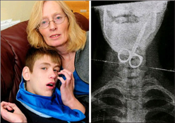 ابتلع مقص أظافر وبدأ يسعل دماً.. لكنه نجا باعجوبة! ابتلع مقص أظافر وبدأ يسعل دماً.. لكنه نجا باعجوبة!