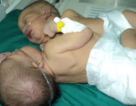 مصر: ولادة توأمان سياميان تشتركان بالقلب والأمعاء!