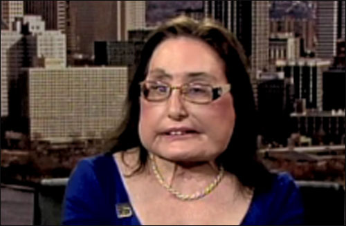 صاحبة اول وجه مزروع بالعالم.. تعود لحياتها الطبيعية!