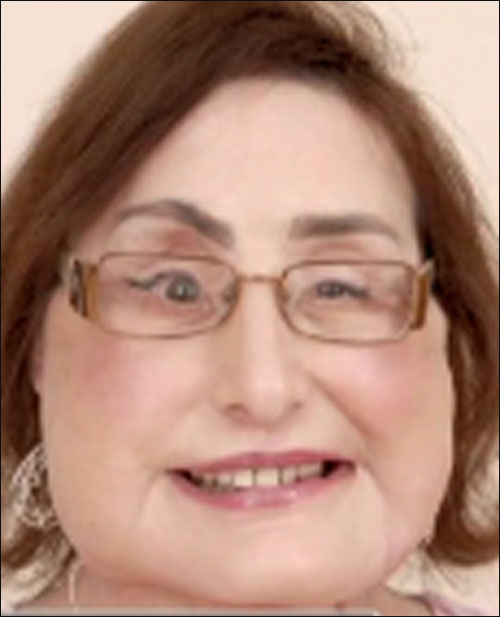 صاحبة اول وجه مزروع بالعالم.. تعود لحياتها الطبيعية!