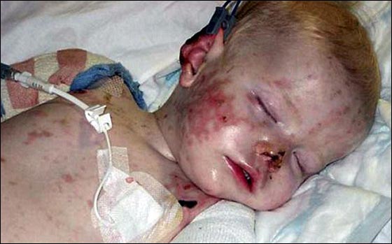 مؤثر جدا.. رحلة طفل بريطاني منذ قطع ساقيه حتى المشي مجددا