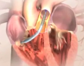 لأول مرة.. عملية زرع صمامات القلب عبر الارجل!!