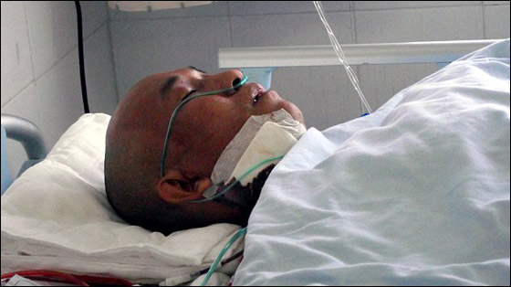 بعد 4 سنوات.. اكتشاف نصل بطول 10 سنتيمترات داخل وجه رجل!