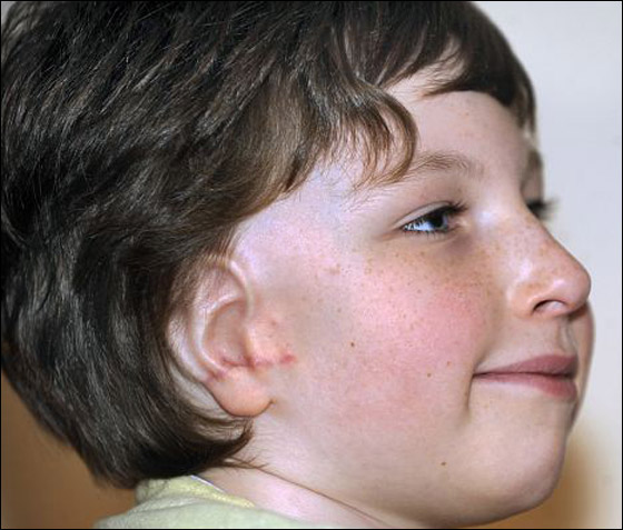 لاول مرة: جراحة نادرة تعيد بناء اذن طفل ولد بدون اذنه اليمنى!