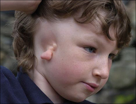 لاول مرة: جراحة نادرة تعيد بناء اذن طفل ولد بدون اذنه اليمنى!