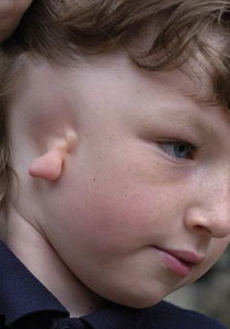 لاول مرة: جراحة نادرة تعيد بناء اذن طفل ولد بدون اذنه اليمنى!