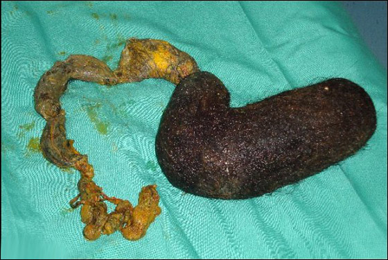 في حالة نادرة.. استئصال كتلة شعر ضخمة من معدة فتاة!!