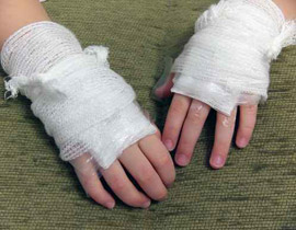 معجزات الطب: اعادة اصابع طفلة بعد تعرضها للبتر!