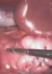 عملية طي المعدة بواسطة المنظار هي الاحدث لخسارة الوزن