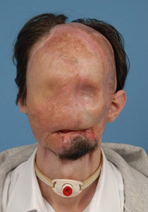 لأول مرة في الطب الامريكي: عملية نقل كامل للوجه تتم بنجاح!!