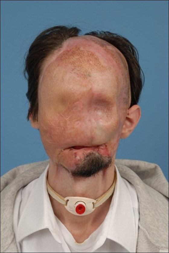 لأول مرة في الطب الامريكي: عملية نقل كامل للوجه تتم بنجاح!! لأول مرة في الطب الامريكي: عملية نقل كامل للوجه تتم بنجاح!!