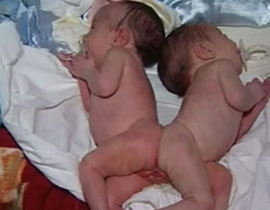 نجاح فصل توامين سياميين بعد امر خادم الحرمين بالتكفل بهما 