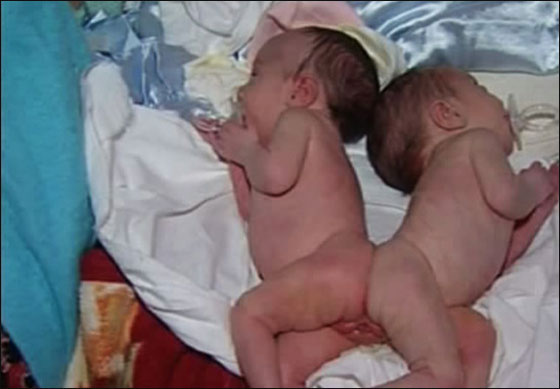 نجاح فصل توامين سياميين بعد امر خادم الحرمين بالتكفل بهما 