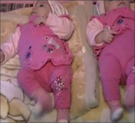 نجاح فصل توامين سياميين بعد امر خادم الحرمين بالتكفل بهما 