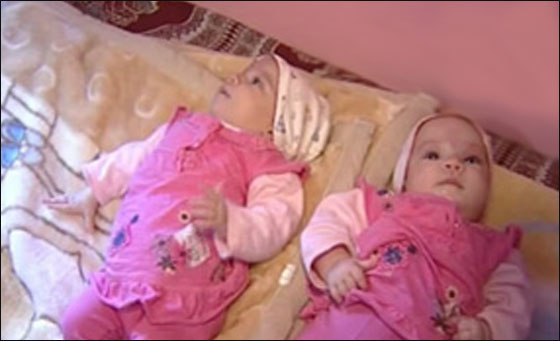 نجاح فصل توامين سياميين بعد امر خادم الحرمين بالتكفل بهما 