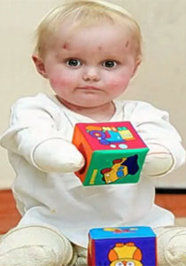 طفلة مبتورة الاطراف تساعد نظيرتها بالتاقلم مع وضعها الحالي