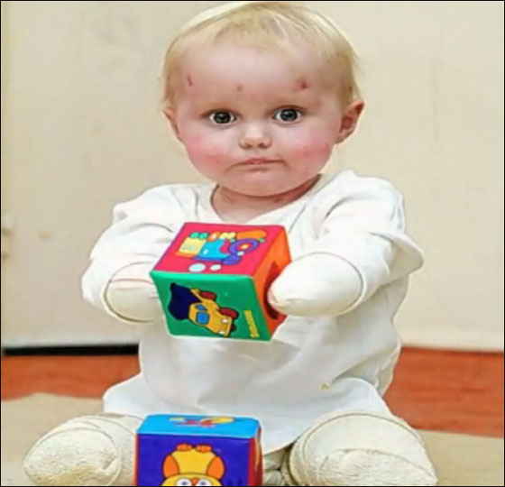 طفلة مبتورة الاطراف تساعد نظيرتها بالتاقلم مع وضعها الحالي