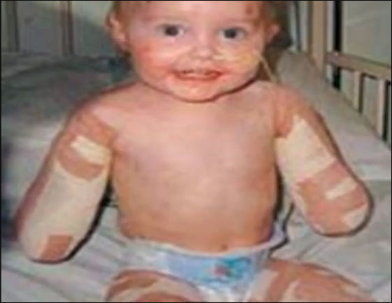 طفلة مبتورة الاطراف تساعد نظيرتها بالتاقلم مع وضعها الحالي