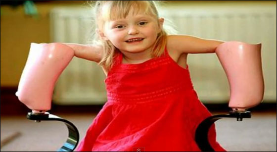 طفلة مبتورة الاطراف تساعد نظيرتها بالتاقلم مع وضعها الحالي