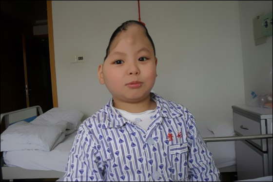 معجزة: عملية جراحية ناجحة تعيد تشكيل جمجمة طفل بنصف رأس!! معجزة: عملية جراحية ناجحة تعيد تشكيل جمجمة طفل بنصف رأس!!