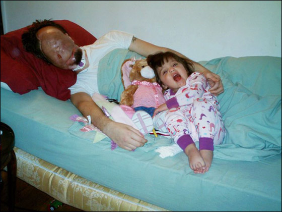 بعد خضوعة لاول عملية نقل وجه.. المريض يستعيد حاسة الشم!!