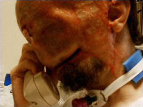 بعد خضوعة لاول عملية نقل وجه.. المريض يستعيد حاسة الشم!!