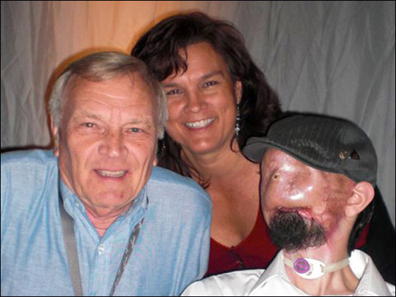 بعد خضوعة لاول عملية نقل وجه.. المريض يستعيد حاسة الشم!!