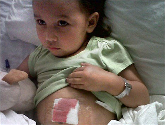 نجاة طفلة باعجوبة بعدما ابتلعت مفك براغي استقر في امعائها 