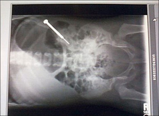 نجاة طفلة باعجوبة بعدما ابتلعت مفك براغي استقر في امعائها 