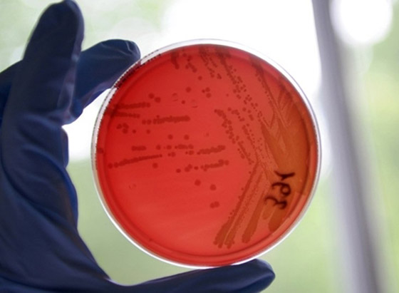 بكتيريا من نوع E.coli تنتشر بشكل خطير وتسبب وفيات