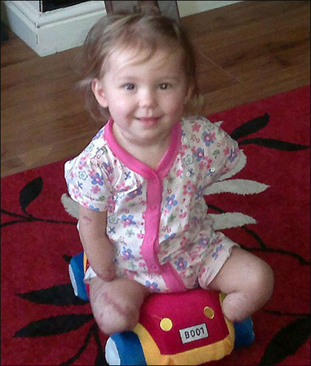 طفلة مبتورة الاطراف ترتدي حذائها المفضل مجددا بفضل ساقي الاميرة