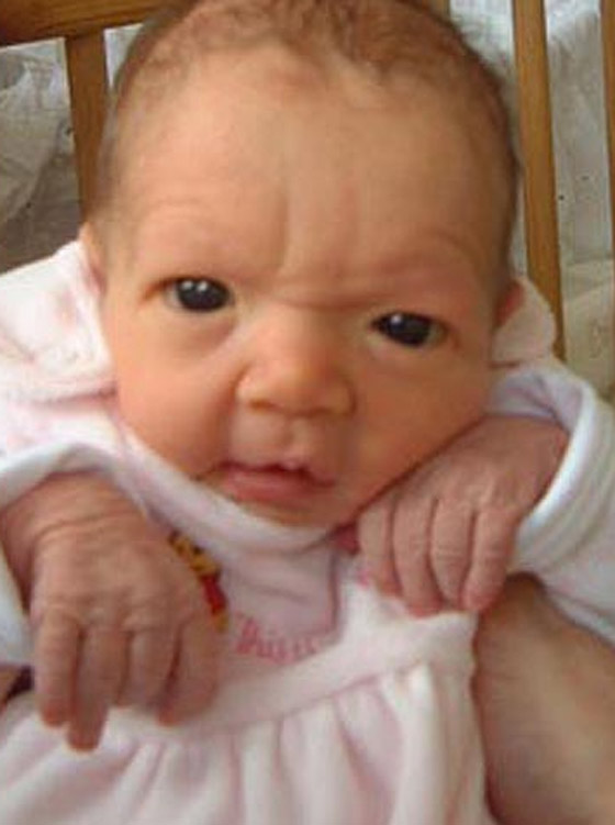 مرض الشيخوخة المبكر يصيب طفلتان وهما في أول العمر!