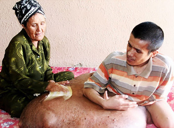فيتنامي يعاني من أكبر ورم في العالم برجله يزن 80 كلغم