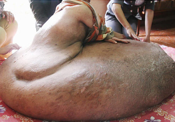 فيتنامي يعاني من أكبر ورم في العالم برجله يزن 80 كلغم