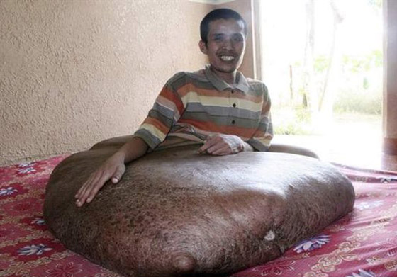 فيتنامي يعاني من أكبر ورم في العالم برجله يزن 80 كلغم