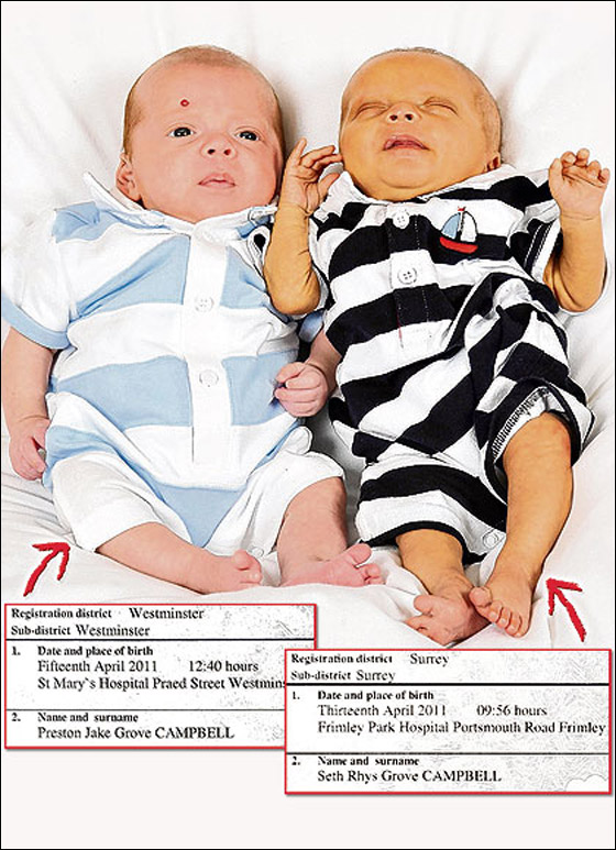 في سابقة هي الاولى من نوعها:  ولادة توأمان بفارق يومين!!