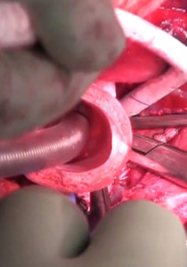 أول عملية زرع قصبة هوائية اصطناعية دون حاجة لمتبرع!