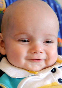 اطباء يحطمون جمجمة رضيع أُصيب بتشوه بارأس لانقاذ حياته!!