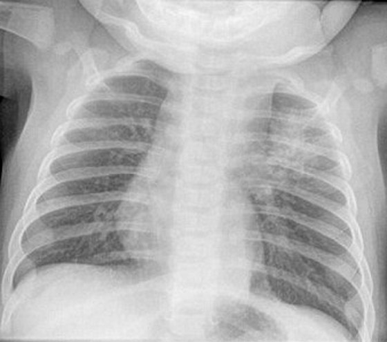 حالة مميتة: طفل يعاني من 20 ورم في انحاء جسده المختلفة!