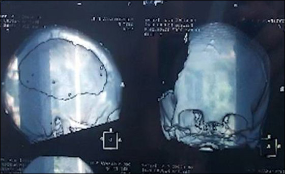 روسية تتحدى تدمر نصف مخها وشللها بممارسة الرسم 