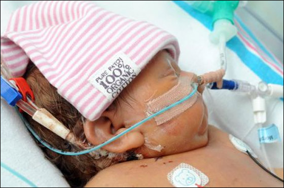 طفلة (4 اشهر) تنتظر وجود متبرع مناسب لاجراء عملية زراعة كبد!!