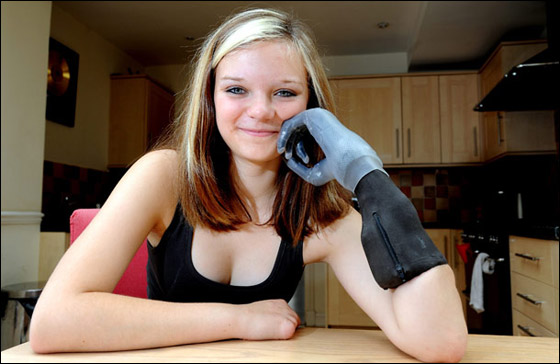 تركيب أصابع كمبيوترية لكف مراهقة بريطانية يعيد لها الحياة!! 